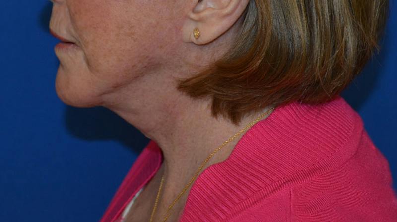 Neck Lift Before & After Gallery - Patient 152038 - Image 4