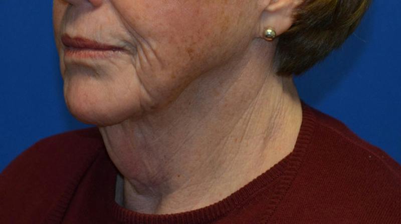 Neck Lift Before & After Gallery - Patient 152038 - Image 5