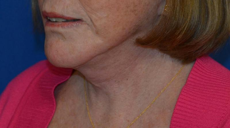 Neck Lift Before & After Gallery - Patient 152038 - Image 6