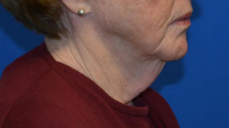 Neck Lift Before & After Gallery - Patient 152038 - Image 7