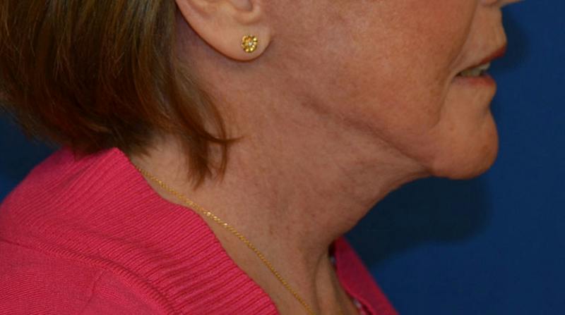 Neck Lift Before & After Gallery - Patient 152038 - Image 8