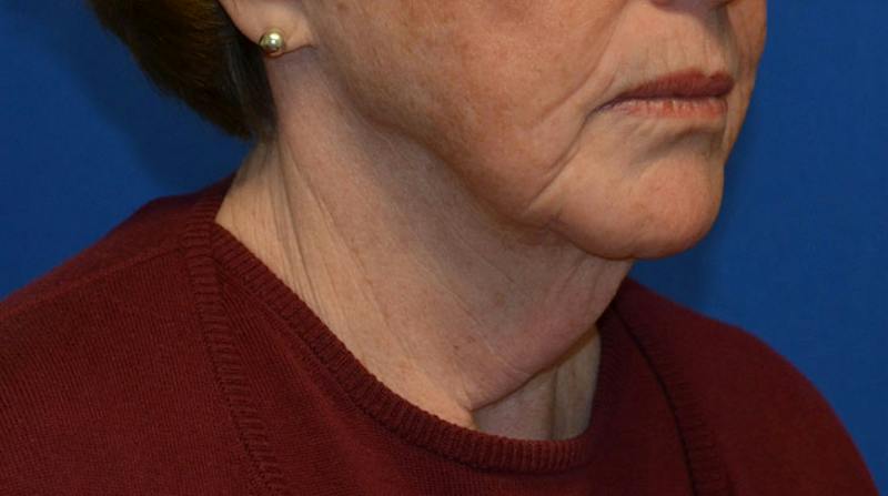 Neck Lift Before & After Gallery - Patient 152038 - Image 9