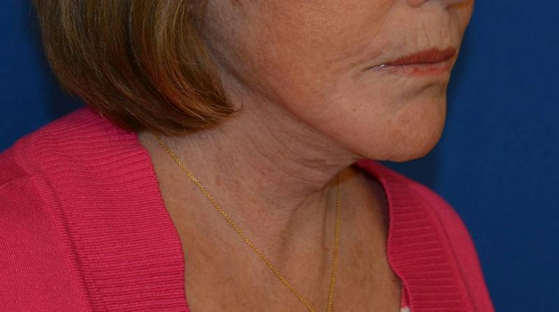 Neck Lift Before & After Gallery - Patient 152038 - Image 10
