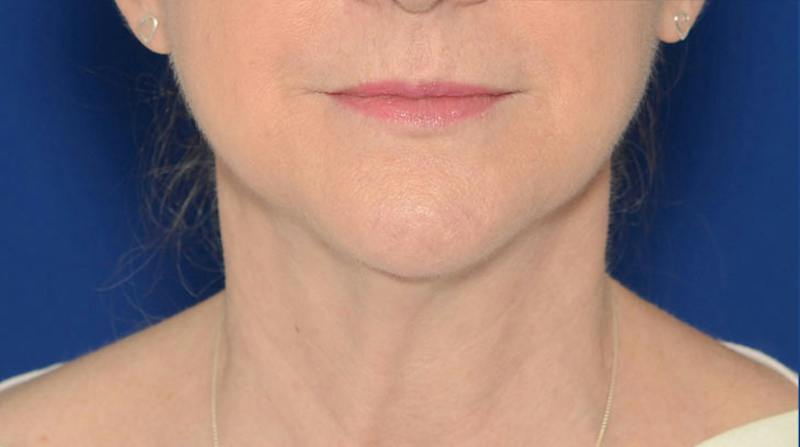 Neck Lift Before & After Gallery - Patient 174654 - Image 1