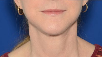 Neck Lift Before & After Gallery - Patient 174654 - Image 2