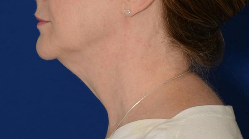 Neck Lift Before & After Gallery - Patient 174654 - Image 3