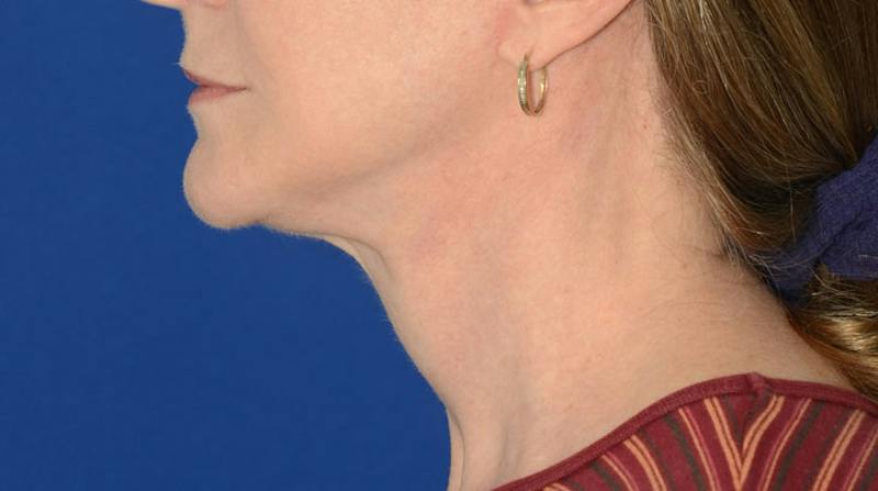 Neck Lift Before & After Gallery - Patient 174654 - Image 4
