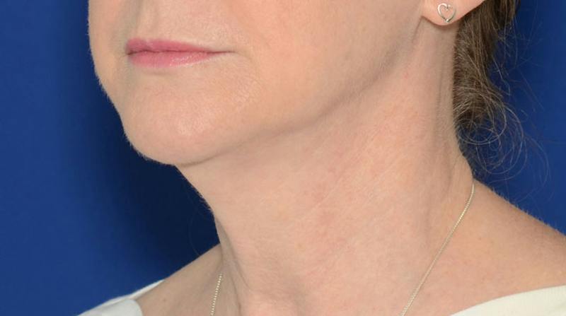 Neck Lift Before & After Gallery - Patient 174654 - Image 5