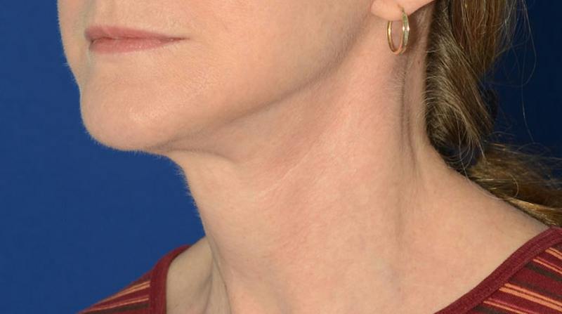 Neck Lift Before & After Gallery - Patient 174654 - Image 6