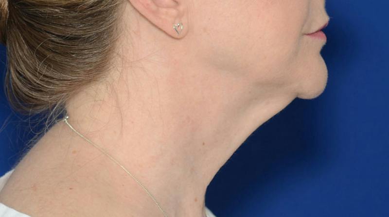 Neck Lift Before & After Gallery - Patient 174654 - Image 7
