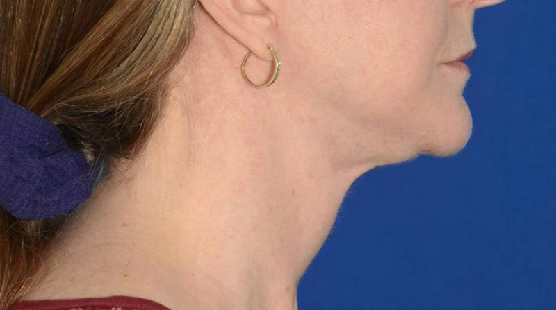 Neck Lift Before & After Gallery - Patient 174654 - Image 8