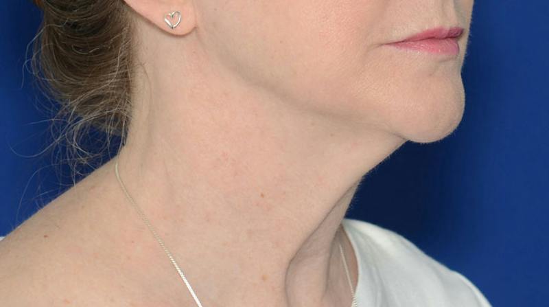 Neck Lift Before & After Gallery - Patient 174654 - Image 9