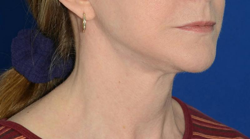 Neck Lift Before & After Gallery - Patient 174654 - Image 10