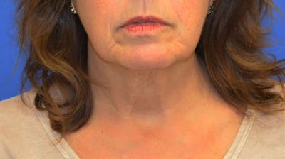 Neck Lift Before & After Gallery - Patient 363798 - Image 1