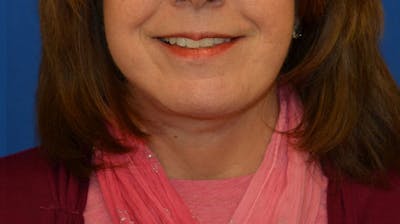 Neck Lift Before & After Gallery - Patient 363798 - Image 2