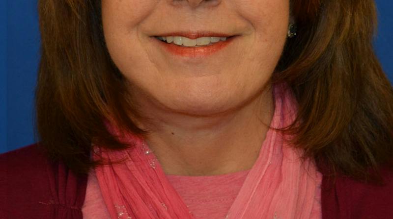 Neck Lift Before & After Gallery - Patient 363798 - Image 2