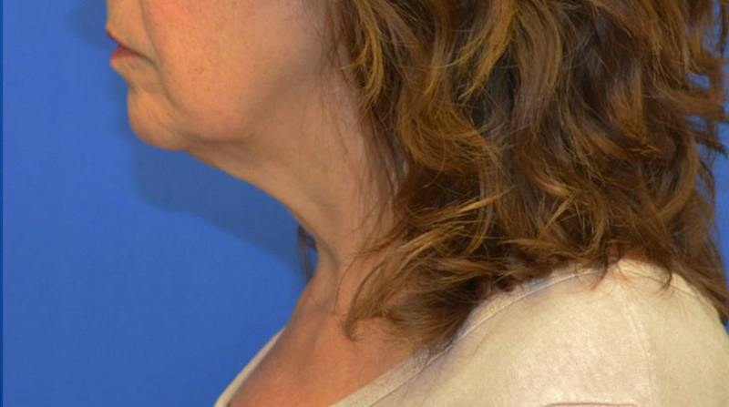 Neck Lift Before & After Gallery - Patient 363798 - Image 3
