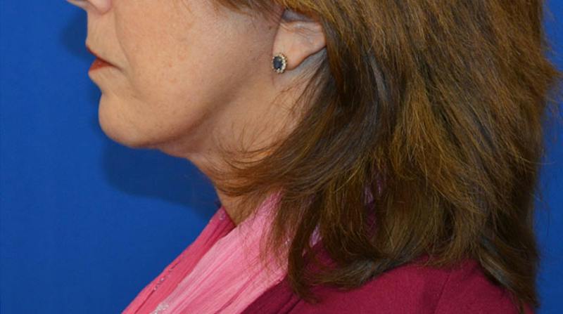Neck Lift Before & After Gallery - Patient 363798 - Image 4