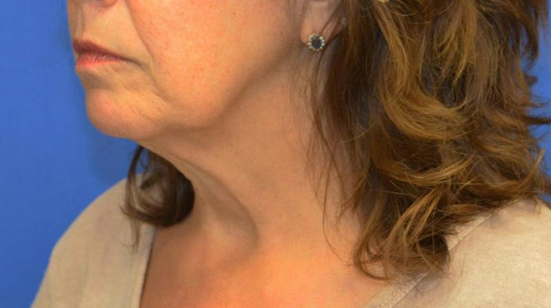 Neck Lift Before & After Gallery - Patient 363798 - Image 5