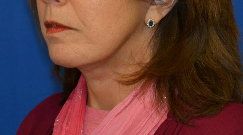 Neck Lift Before & After Gallery - Patient 363798 - Image 6