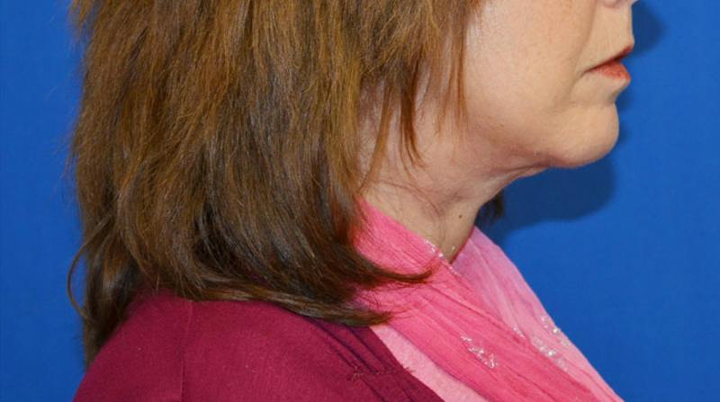 Neck Lift Before & After Gallery - Patient 363798 - Image 8