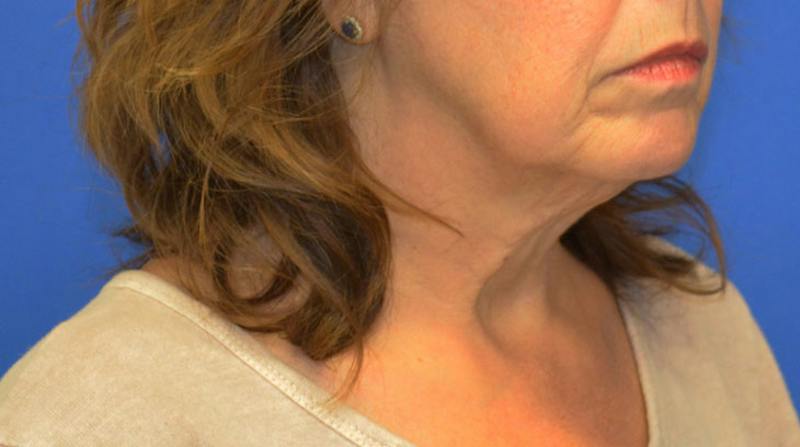 Neck Lift Before & After Gallery - Patient 363798 - Image 9