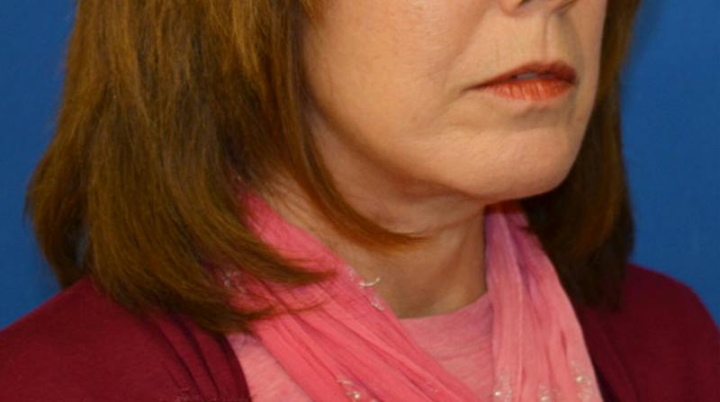 Neck Lift Before & After Gallery - Patient 363798 - Image 10