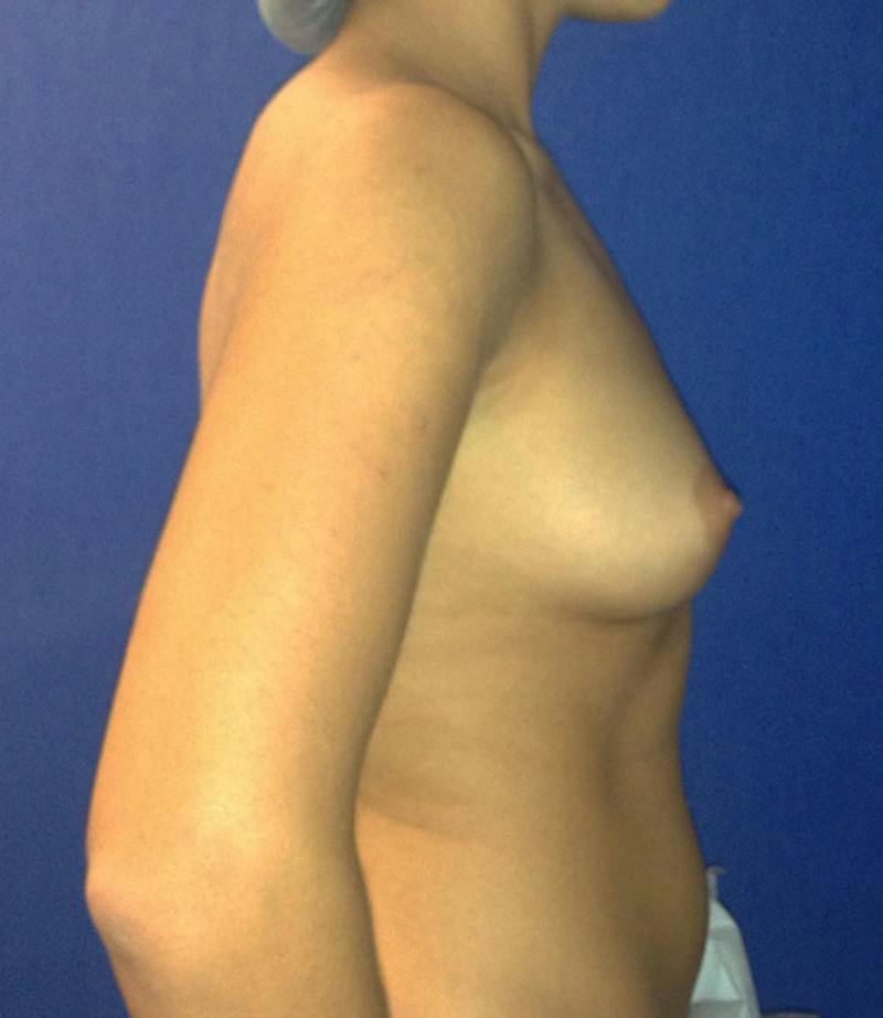 Breast Augmentation Before & After Gallery - Patient 436742 - Image 7