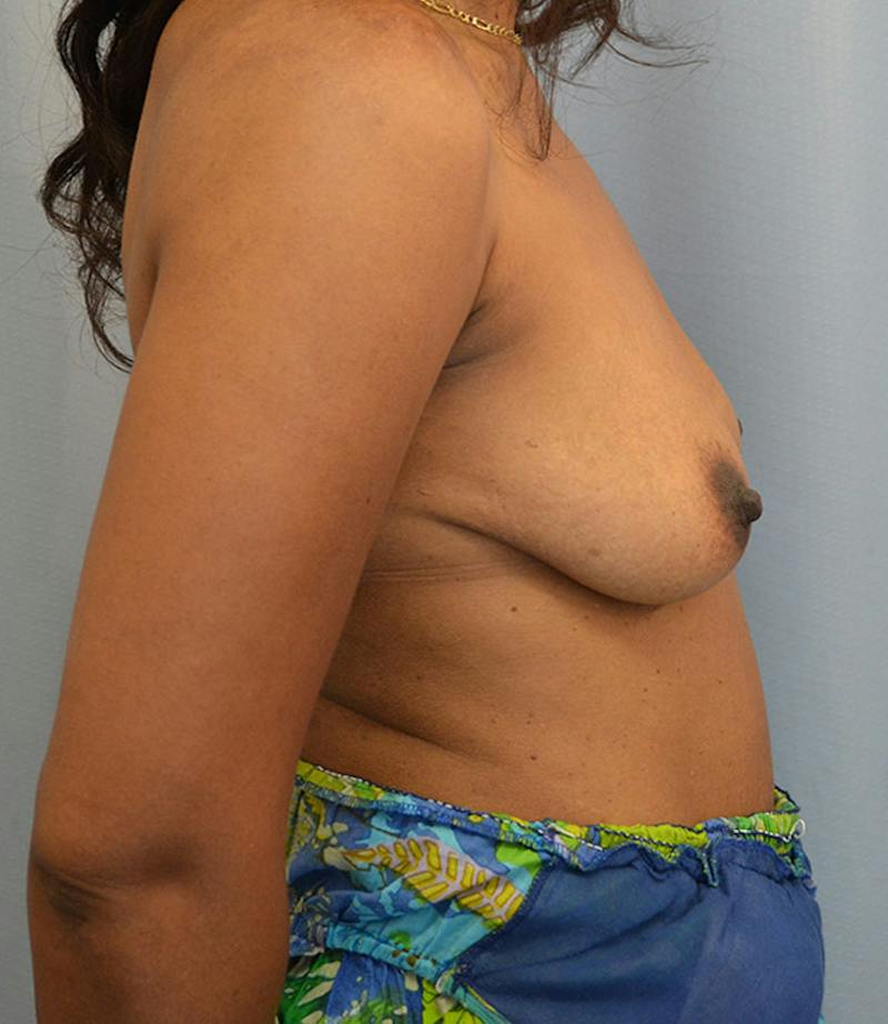 Breast Augmentation Before & After Gallery - Patient 284680 - Image 7