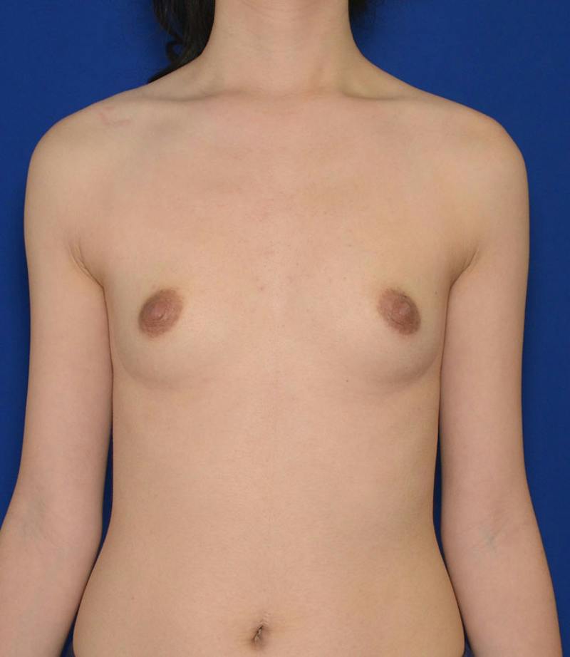 Breast Augmentation Before & After Gallery - Patient 352812 - Image 1