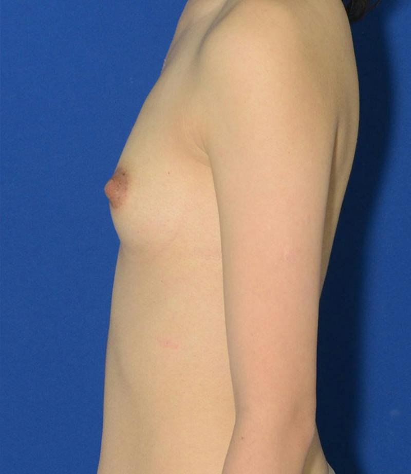 Breast Augmentation Before & After Gallery - Patient 352812 - Image 3