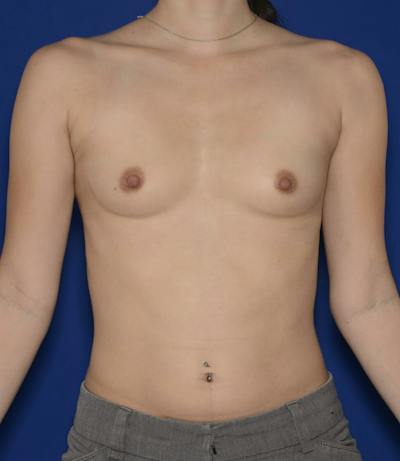 Breast Augmentation Before & After Gallery - Patient 348733 - Image 1