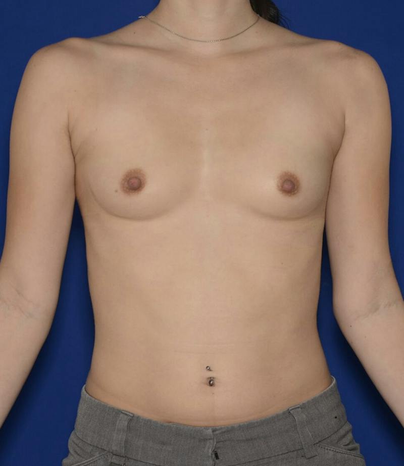 Breast Augmentation Before & After Gallery - Patient 348733 - Image 1