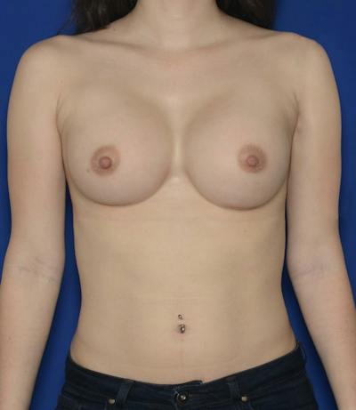 Breast Augmentation Before & After Gallery - Patient 348733 - Image 2