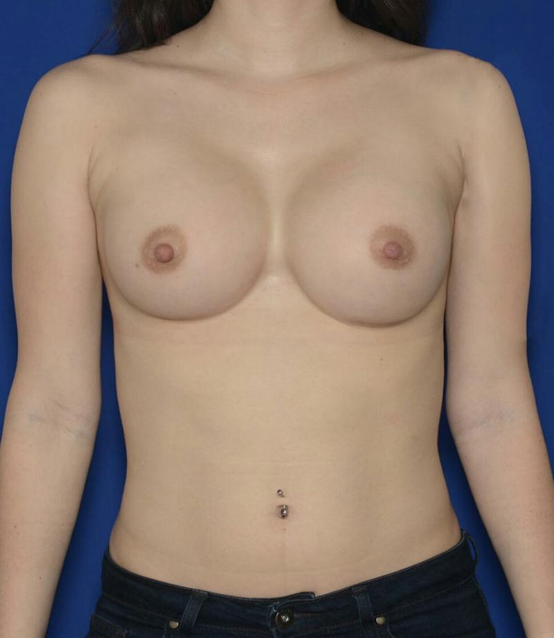 Breast Augmentation Before & After Gallery - Patient 348733 - Image 2