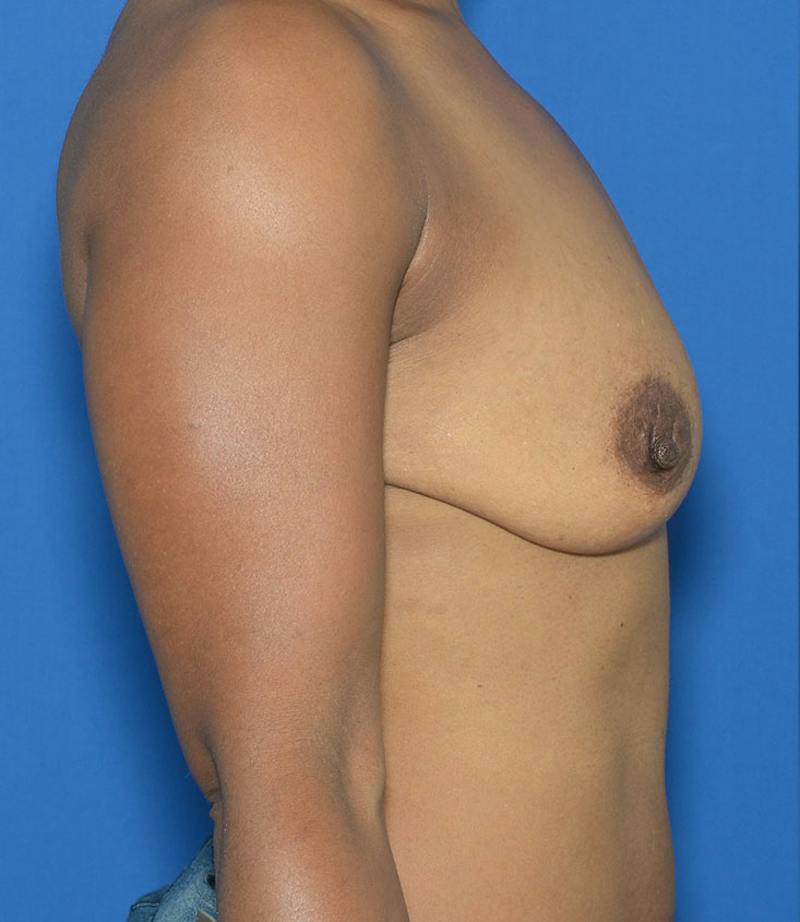 Breast Augmentation And Lift Before & After Gallery - Patient 357956 - Image 7