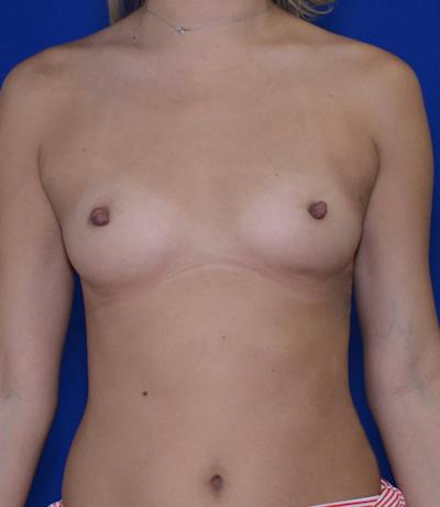 Breast Augmentation Before & After Gallery - Patient 258685 - Image 1