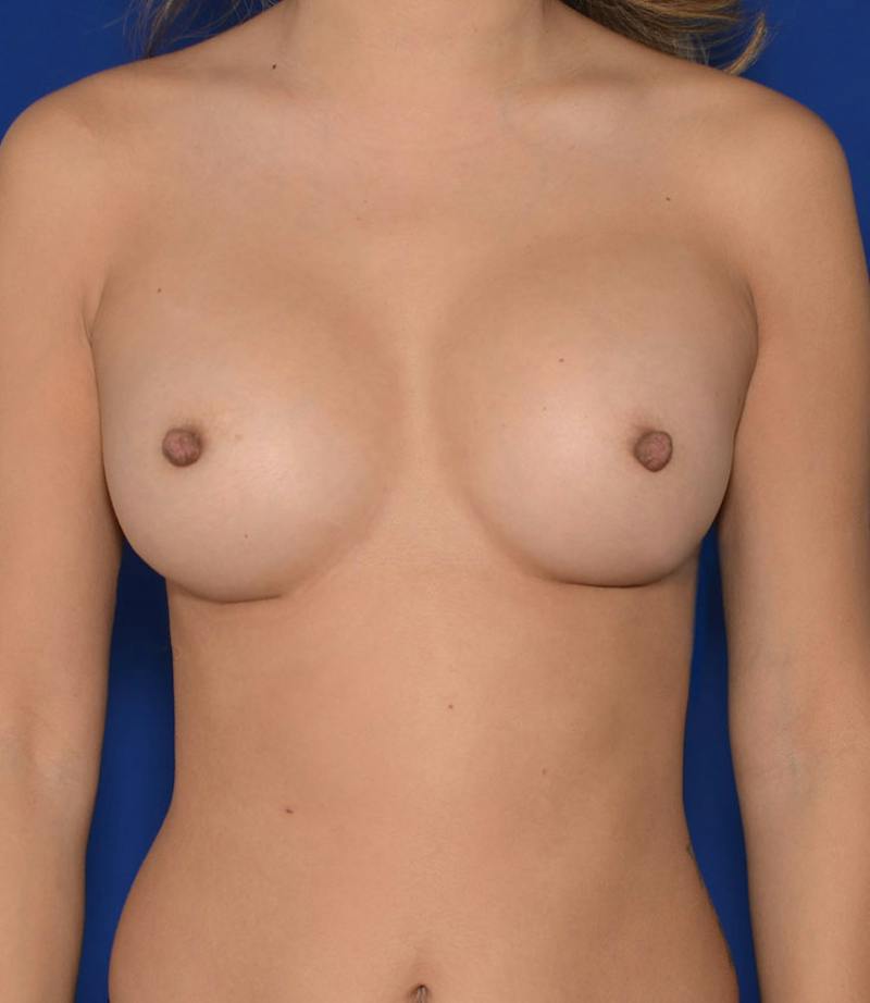 Breast Augmentation Before & After Gallery - Patient 258685 - Image 2