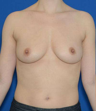Breast Augmentation Before & After Gallery - Patient 368724 - Image 1