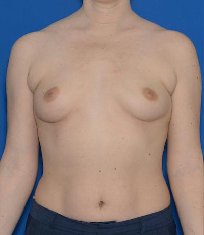 Breast Augmentation Before & After Gallery - Patient 128578 - Image 1