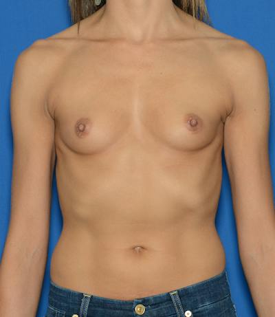Breast Augmentation Before & After Gallery - Patient 639397 - Image 1