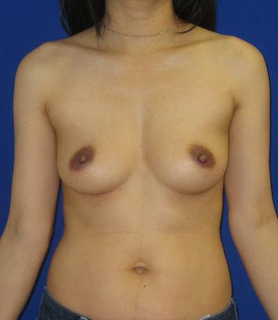Breast Augmentation Before & After Gallery - Patient 278860 - Image 1