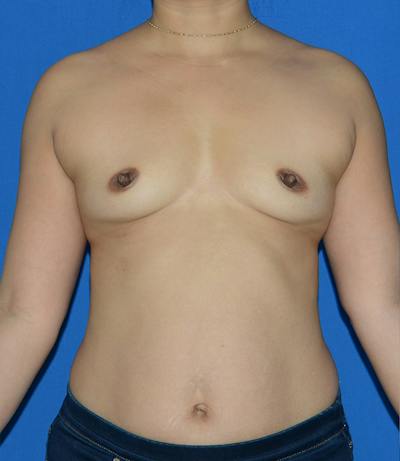 Breast Augmentation Before & After Gallery - Patient 310422 - Image 1