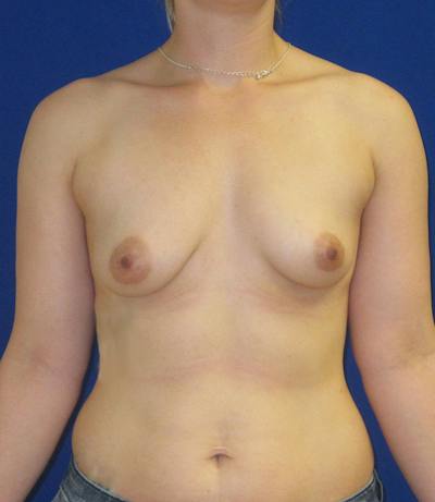 Breast Augmentation Before & After Gallery - Patient 347152 - Image 1