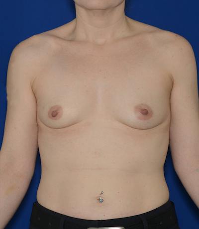 Breast Augmentation Before & After Gallery - Patient 351771 - Image 1