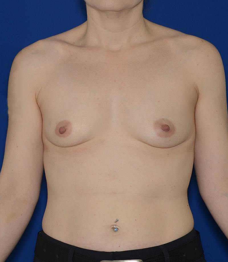 Breast Augmentation Before & After Gallery - Patient 351771 - Image 1