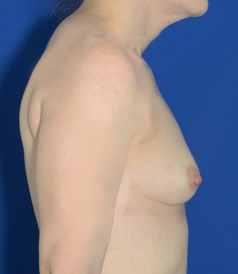 Breast Augmentation Before & After Gallery - Patient 351771 - Image 7