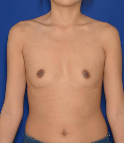 Breast Augmentation Before & After Gallery - Patient 401266 - Image 1