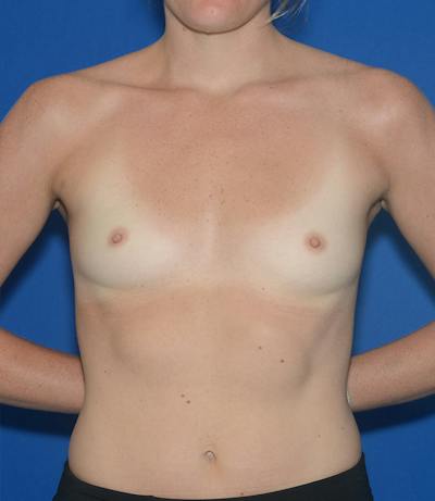 Breast Augmentation Before & After Gallery - Patient 122470 - Image 1