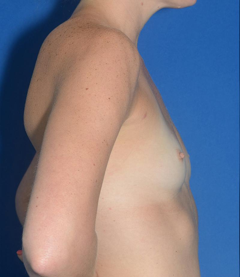 Breast Augmentation Before & After Gallery - Patient 122470 - Image 7